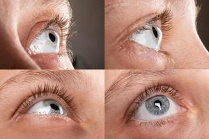 ojo de mujer con distrofia corneal, queratocono, adelgazamiento de la córnea foto