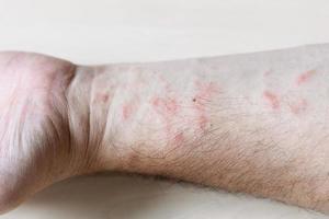 rash on inner side of forearm close up photo