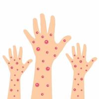 Hands covered with smallpox blisters vector