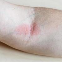 redness on iinner bend of the elbow close up photo
