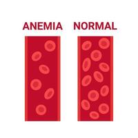 Sangre normal y anemia en comparación de vasos, número de células de circulación eritrocitaria. nivel bajo de hemoglobina, anemia por deficiencia de hierro. células sanguíneas anémicas de la enfermedad. problema de salud. ilustración vectorial vector