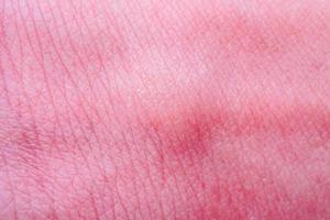alergia en la piel con erupción después de la picadura de mosquito foto