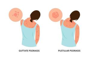 The woman is scratching her back.  Pustular psoriasis.Allergic itching, skin inflammation, redness and irritation. Atopic dermatitis, eczema, psoriasis, dry skin. Skin problems .vector. vector