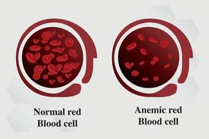 anemia hierro glóbulos rojos medical vector ilustración médica.