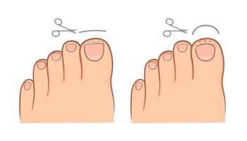 correct and improper cutting of the toenail. medical illustration vector