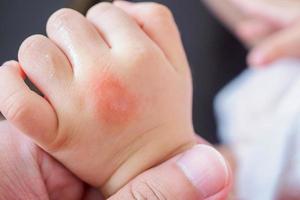 mano de bebé con erupción cutánea y alergia con mancha roja causada por picadura de mosquito foto