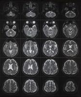 Human brain MRI imaging on light box photo