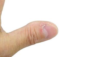 Close-up of thumb and nail with dry skin, torn and flaking off, cracked skin on cuticles, dry brittle nails. Isolated on white background. photo