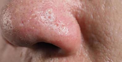 Acne and problem pores. White and blackhead pimples from nose pores. photo