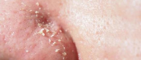 Acne and problem pores. White and blackhead pimples from nose pores. photo