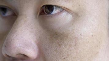 cerrar la cara del hombre asiático con pecas manchas oscuras de la luz ultravioleta, el cuidado de la piel y el concepto de problema de salud foto