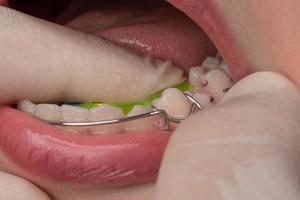 dos dientes de un niño con caries, placa y caries en los dientes. foto