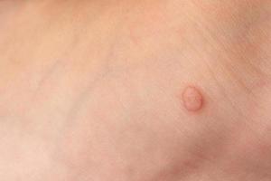 Common wart Verruca vulgaris on the skin of a child. photo