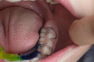placa mandibular, un niño usa una placa para alinear sus dientes. foto