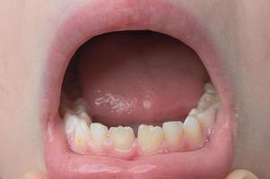 mandíbula con primeros planos de dientes rectos para niños. foto