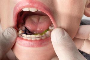 el ortodoncista pone una placa en los dientes inferiores, una visita al ortodoncista. foto