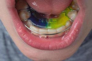 Mandibular plate, a boy wears a plate to align his teeth. photo