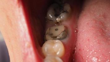 Tratamiento de conductos radiculares de dientes cariados. Diente o caries dental del molar inferior. foto