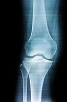Film X-ray leg person photo