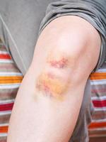 knee injury - bruise on leg photo