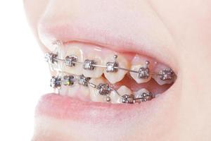 side view of dental braces on teeth close up photo