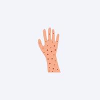 Allergy on hands. Skin covered destruction red rash and scaling serious problems with psoriasis and eczema of epidermis severe allergic dermatitis with rash vector urticaria.