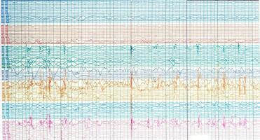 Photography of brain waves  of epileptic patient showing sharp wave during  no seizure or interictal EEG. photo