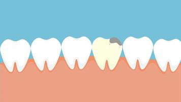 rimozione un' morto dente e sostituzione esso con un' nuovo uno 4k animazione. dentale chirurgia e denti sostituzione concetto 4k filmato. dentista rimozione un' morto dente con un' dentale pinza e sostituzione un' nuovo uno. video