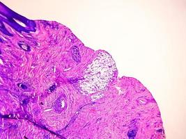 High magnification of skin cells infected with the HPV Virus. Common Wart. Verruca vulgaris. Microscopic view. photo