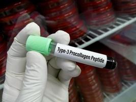 Blood sample for Type III procollagen peptide  test, to diagnose hepatic fibrosis. liver disease. photo