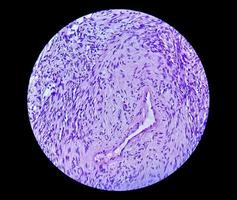 Photomicrograph of a schwannoma, a benign soft tissue tumor of peripheral nerve sheath. photo