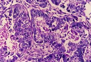 Photomicrograph or microscopic image of Stomach cancer. Adenocarcinoma of stomach photo