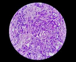 fotomicrografía o imagen microscópica del cáncer de estómago. adenocarcinoma de estómago foto