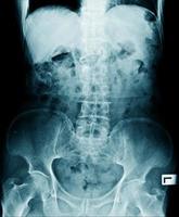 x-ray image of lumbo sacral photo