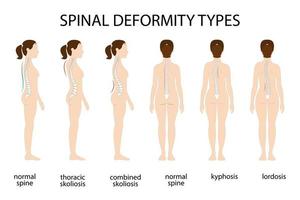 Tipos de deformación de la columna vertebral y afiche de diagrama de comparación de la columna vertebral saludable con curvaturas de la columna vertebral. perfil femenino y vista posterior. información quiropráctica. vector