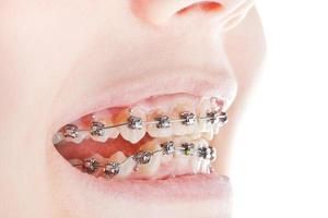 dental braces on teeth close up photo