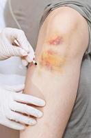 iodine grid painting of knee bruise photo