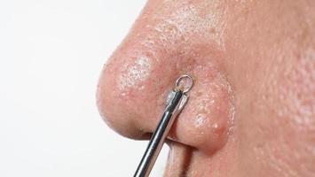 Acne and problem pores. White and blackhead pimples from nose pores. photo