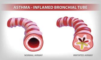 The illustration shows two parts of the bronchi, one normal and the other bronchitis and filled with sputum. vector