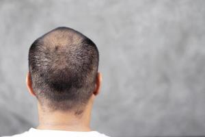 Bald man with hair problems photo