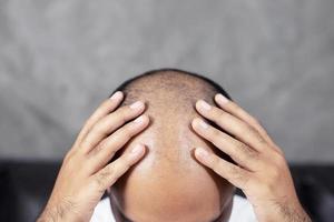 Bald man with hair problems photo