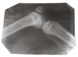 X-ray photo of human knee joint isolated
