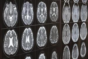 Imagings of brain MRI on the light box photo