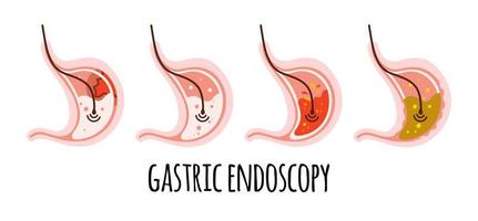 The stomach of a healthy person, with ulcers, gastritis, acidity. Gastroenterology. Vector illustration in a flat style.