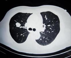 Ct scan film of lung cancer in black and white close up. photo