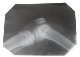 imagen de rayos x de la articulación de la rodilla humana foto