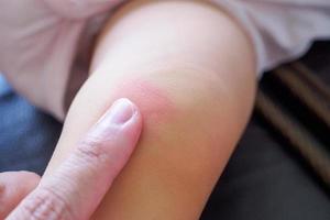 mother apply antiallergic cream at baby knee with skin rash and allergy with red spot cause by mosquito bite photo