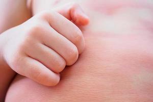 little asian baby girl hand scratch on her body with skin rash itchy and allergy photo