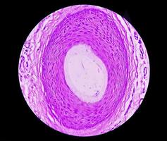 Biopsia histológica de pared escrotal bajo microscopía que muestra calcinosis cutis. calcinosis escrotal. calcinosis cutis del escroto foto