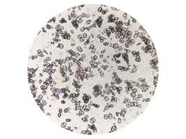 Microscopic image showing calcium oxalate monohydrate, uric acid crystals and triple phosphate crystals from urine sediment. UTI. kidney disease. photo